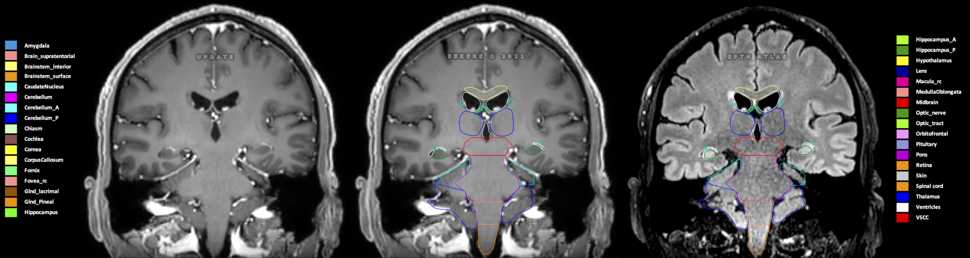 Z=-1.42